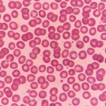 Normal red blood cells